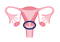 図：子宮頸がん