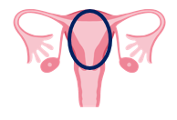 図：子宮体がん